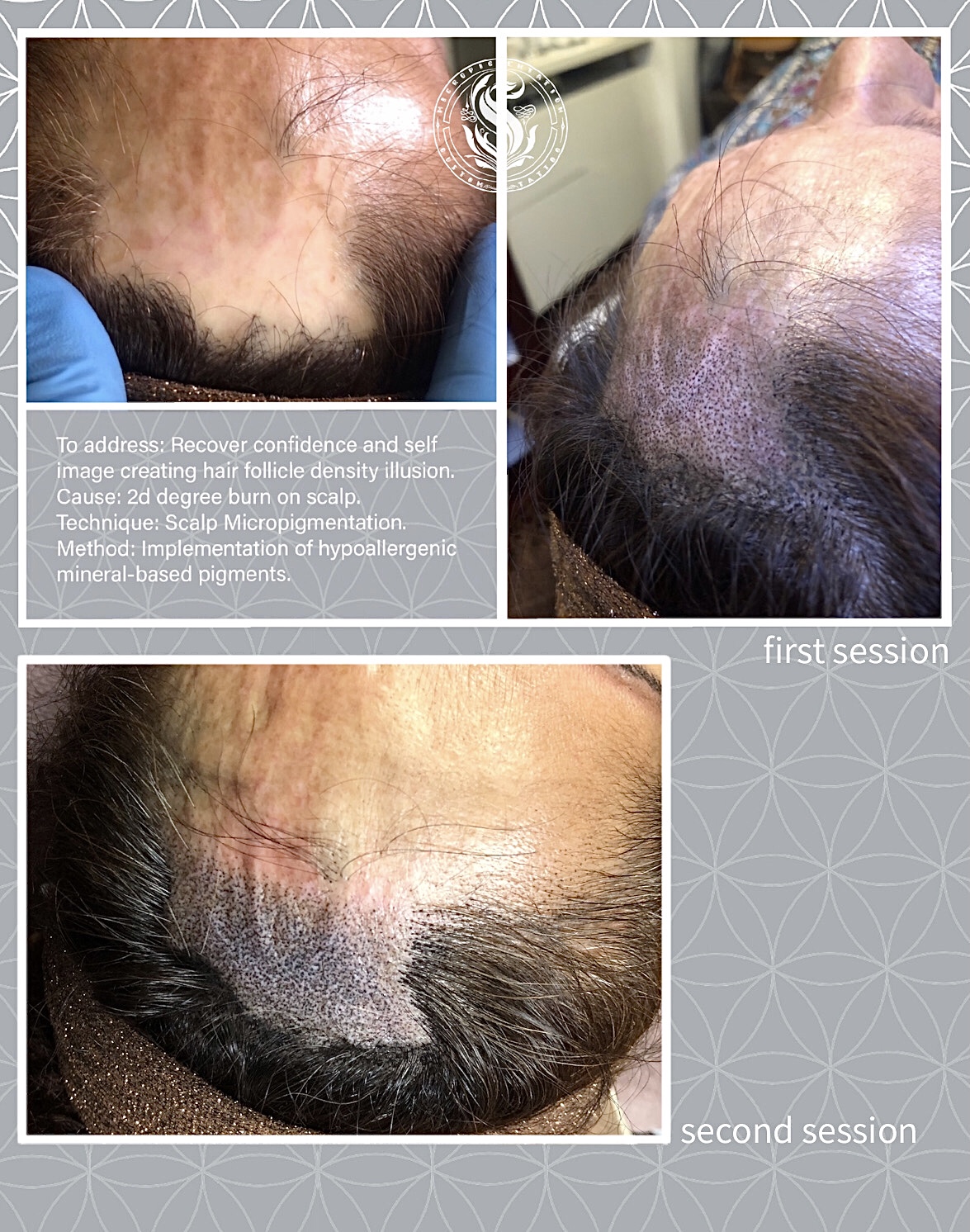 Micropigmentation Scalp Bélgica