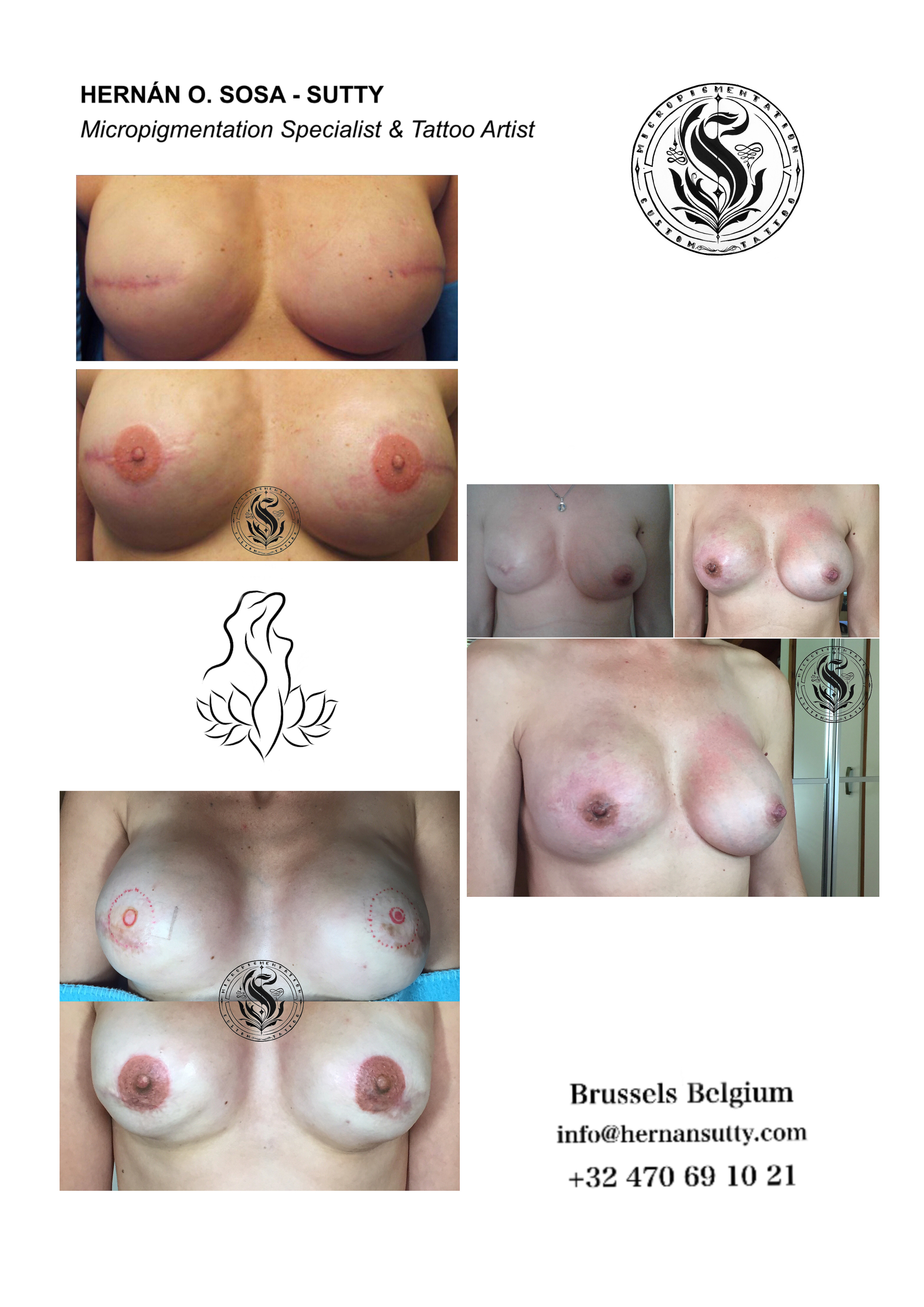 Areola aesthetic reconstruction 