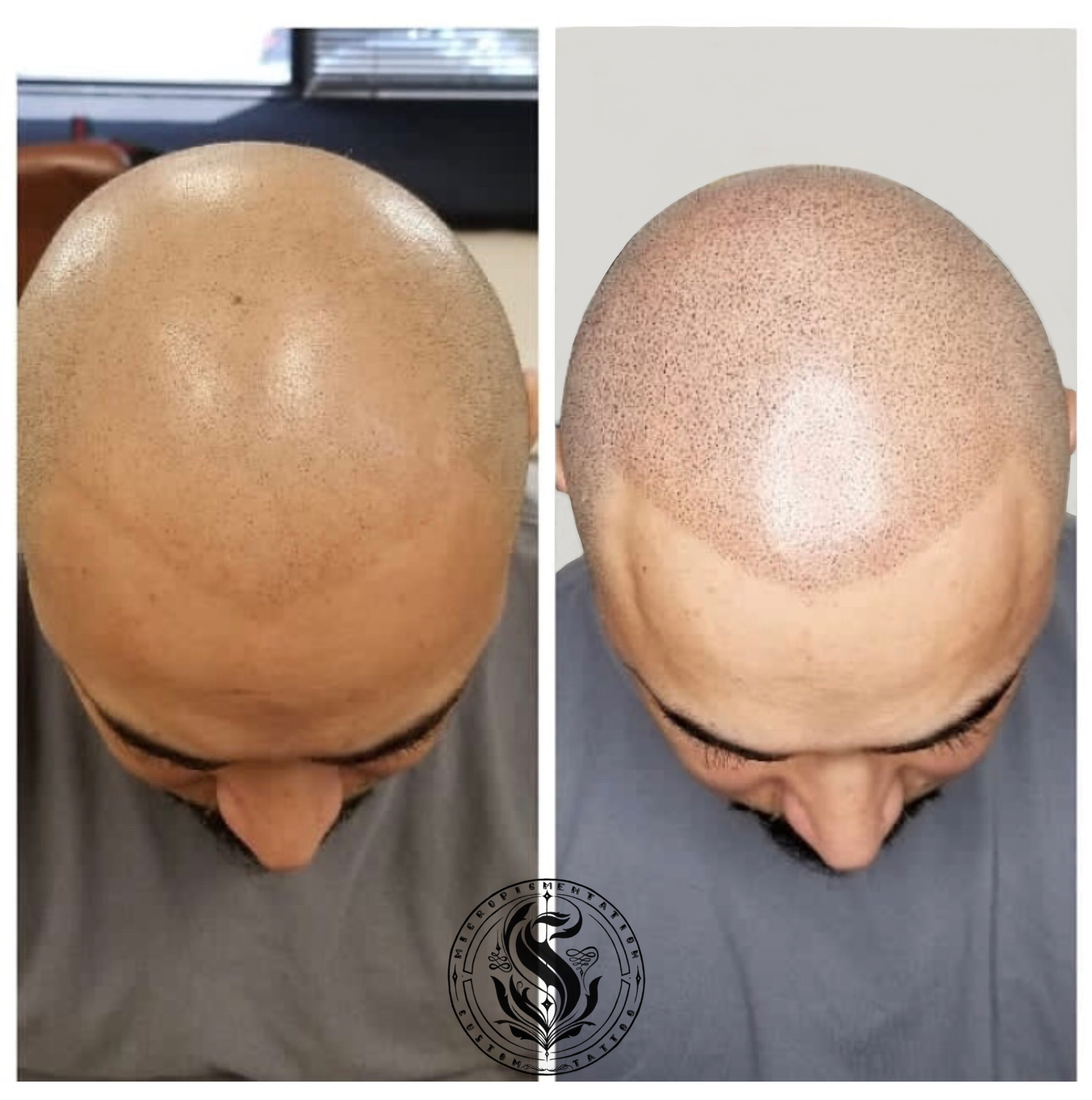 Micropigmentation Scalp México