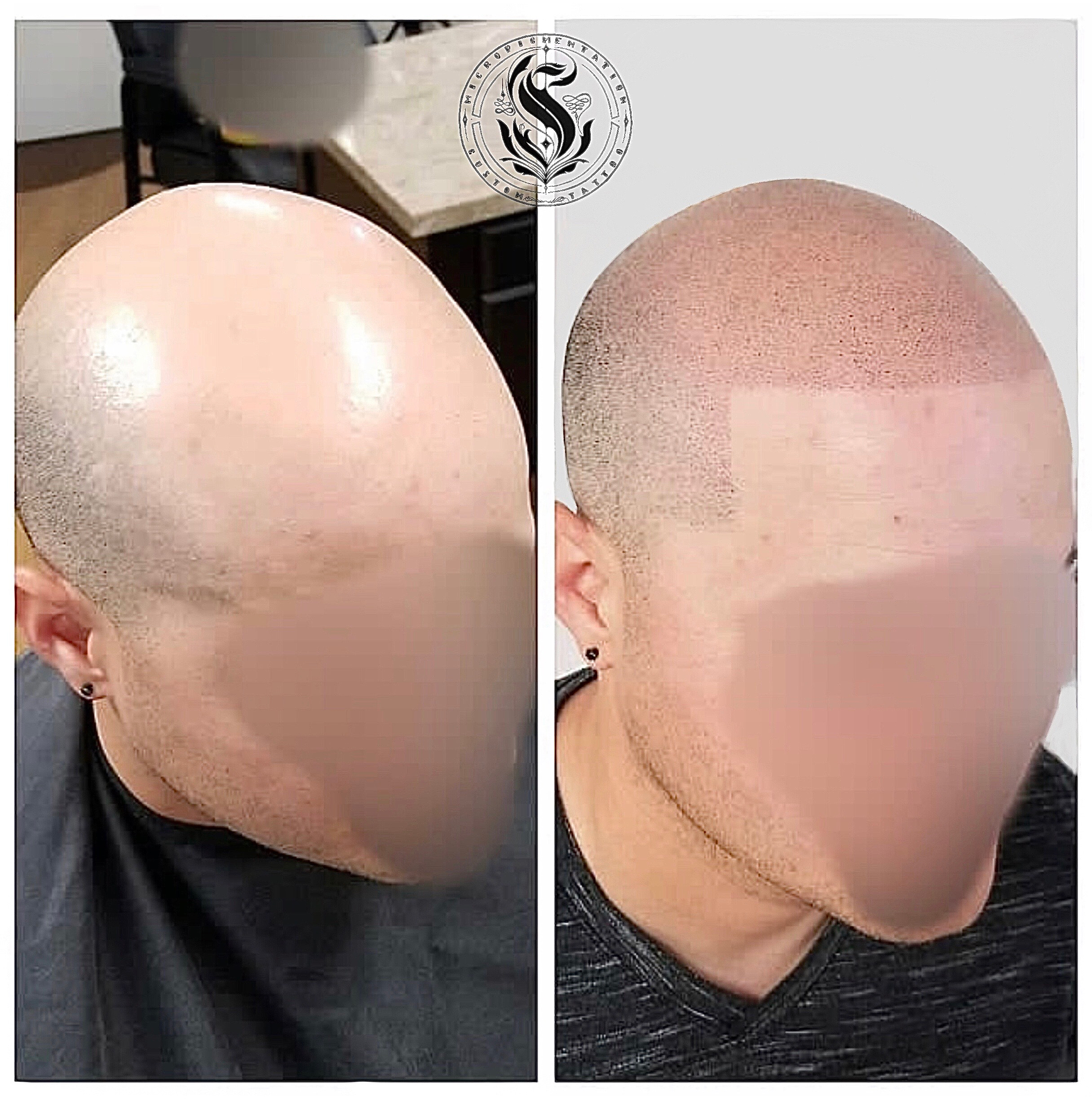 Micropigmentation Scalp México