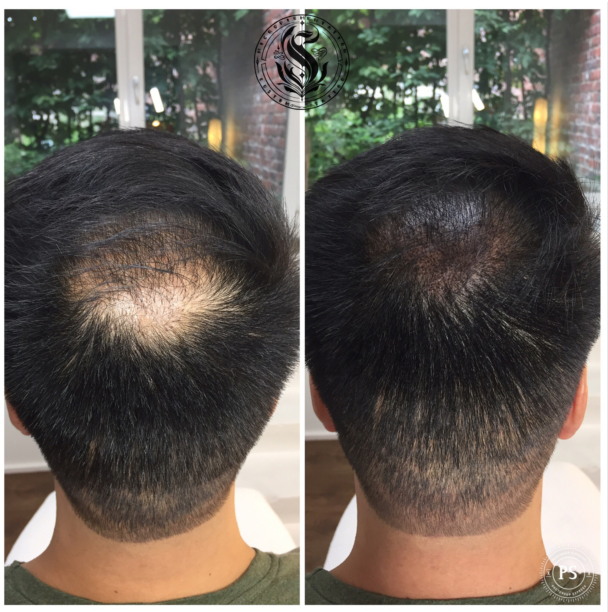 Micropigmentation Scalp Bélgica