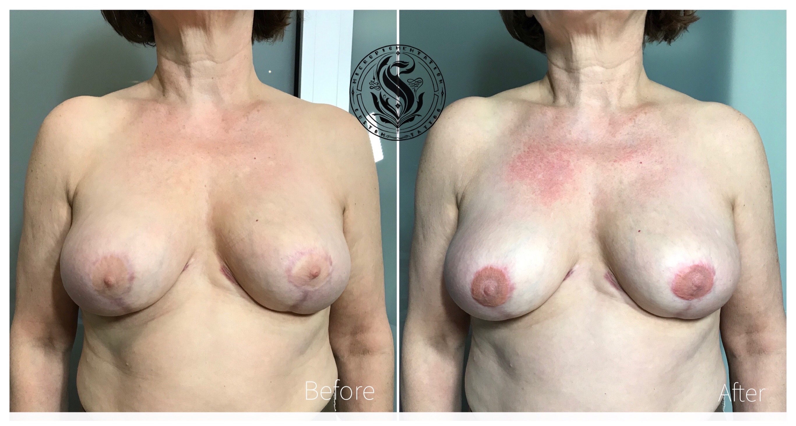 Areola aesthetic reconstruction Bélgica